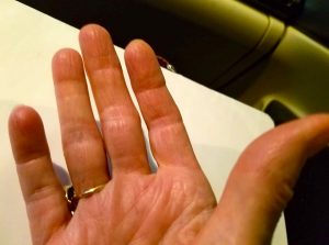 hand burn